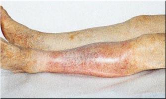 Behandeling van atherosclerose met folk remedies