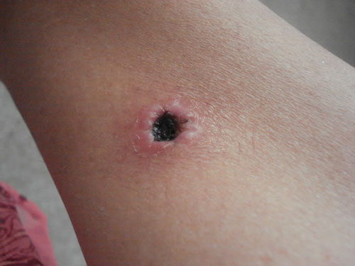 Wat is een fistel? Symptomen, foto's, fistelbehandeling