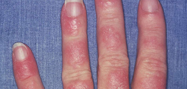 Wat is lupus? Symptomen en oorzaken van de ziekte