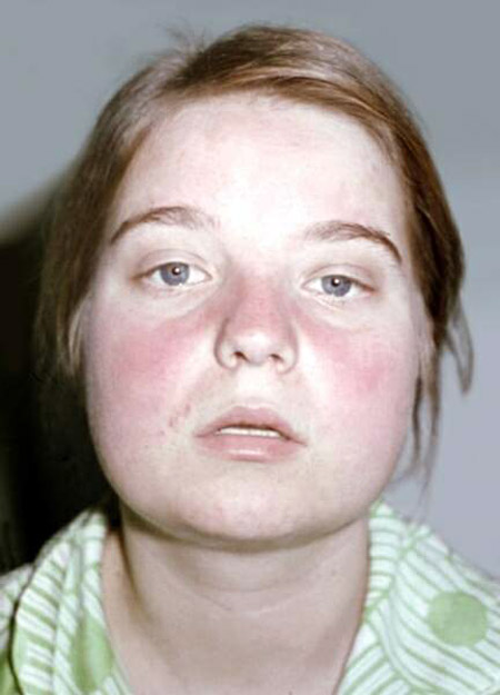 Wat is lupus? Symptomen en oorzaken van de ziekte