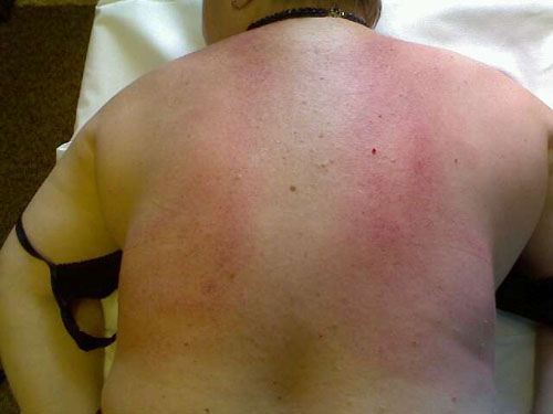 Moeten er blauwe plekken blijven na de massage