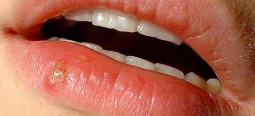 recepten voor de behandeling van verkoudheid op de lippen