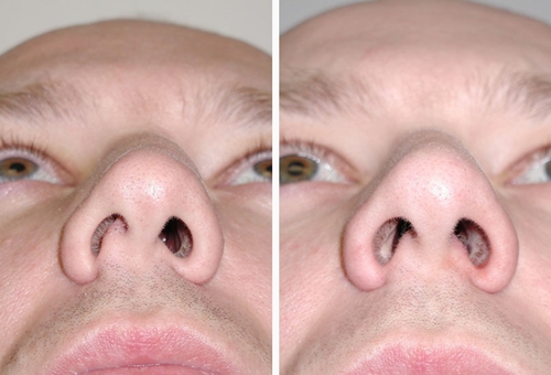 Hoe de kromming van het neustussenschot te behandelen: chirurgie, lasercorrectie