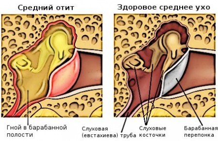 Hoe behandel je otitis thuis?
