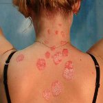 Hoe psoriasis behandelen? Hoe psoriasis behandelen?