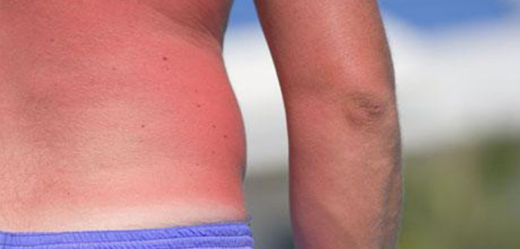 De huid is verschroeid in de zon. Wat moet ik doen? Recepten, maskers, tips