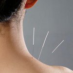 Behandeling met acupunctuur Behandeling met acupunctuur