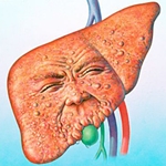 Behandeling van obesitas van de lever: dieet en volksremedies