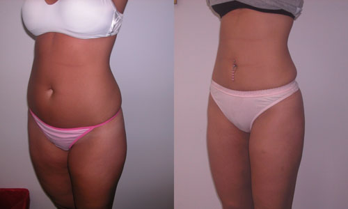 Liposuctie van de buik en dijen: beoordelingen, foto's voor en na
