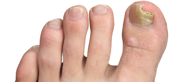 De beste remedies voor nagelschimmel op benen en handen