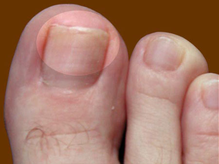 De beste remedies voor nagelschimmel op benen en handen