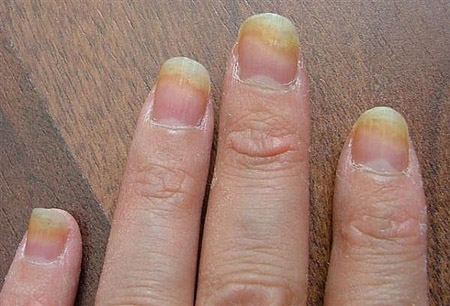 De beste remedies voor nagelschimmel op benen en handen