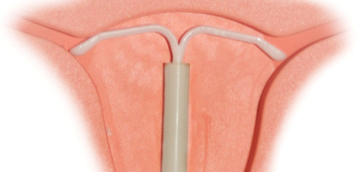 Is het mogelijk om een ​​intra-uterine apparaat voor nullipare vrouwen te plaatsen