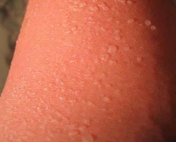 Zonnebrand