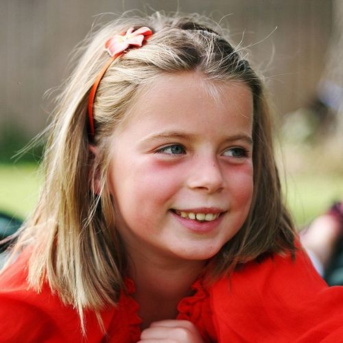 Donkere kringen onder de ogen van een kind: preventiemaatregelen