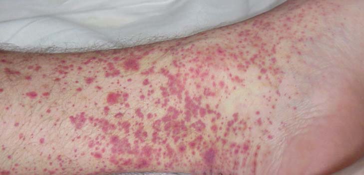 Vasculitis - wat is het? Symptomen, foto's, behandeling